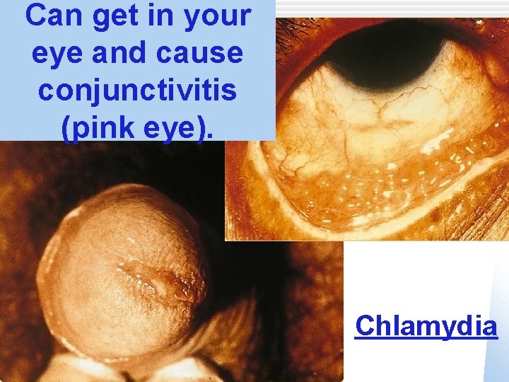 Can get in your eye and cause conjunctivitis (pink eye). Chlamydia 