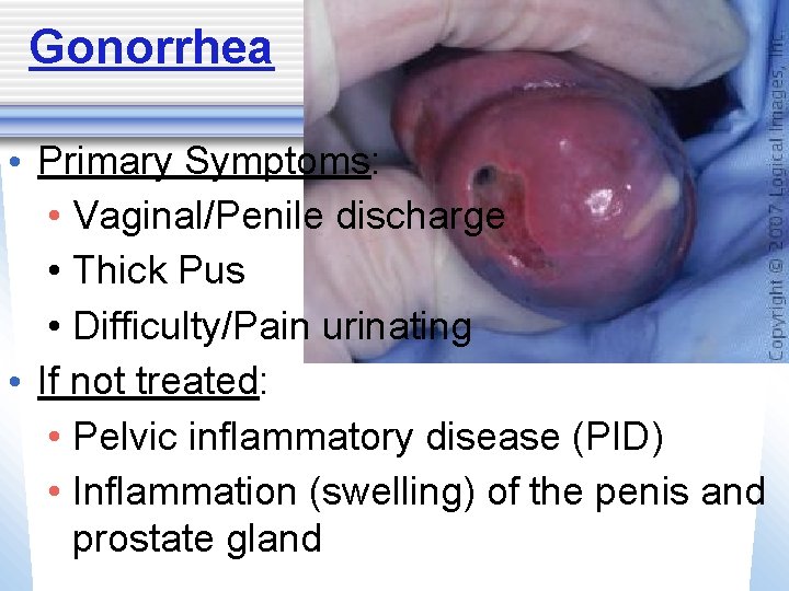 Gonorrhea • Primary Symptoms: • Vaginal/Penile discharge • Thick Pus • Difficulty/Pain urinating •
