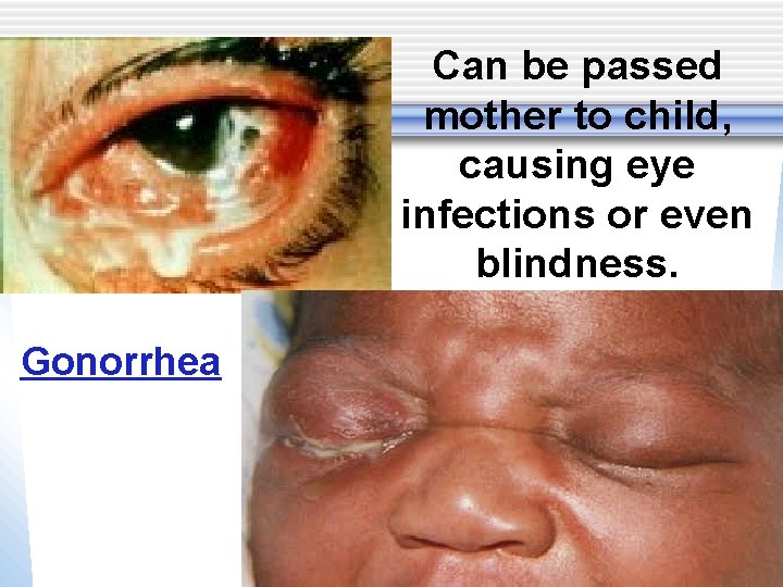 Can be passed mother to child, causing eye infections or even blindness. Gonorrhea 