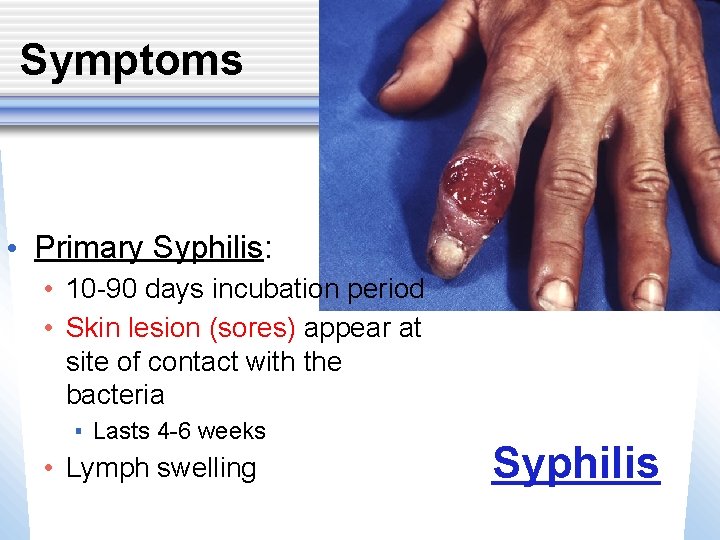 Symptoms • Primary Syphilis: • 10 -90 days incubation period • Skin lesion (sores)
