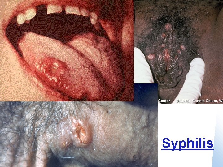 Syphilis 