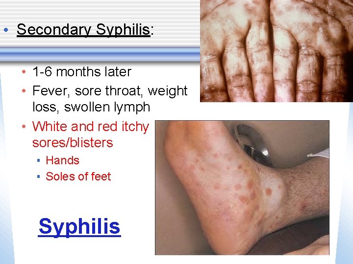  • Secondary Syphilis: • 1 -6 months later • Fever, sore throat, weight