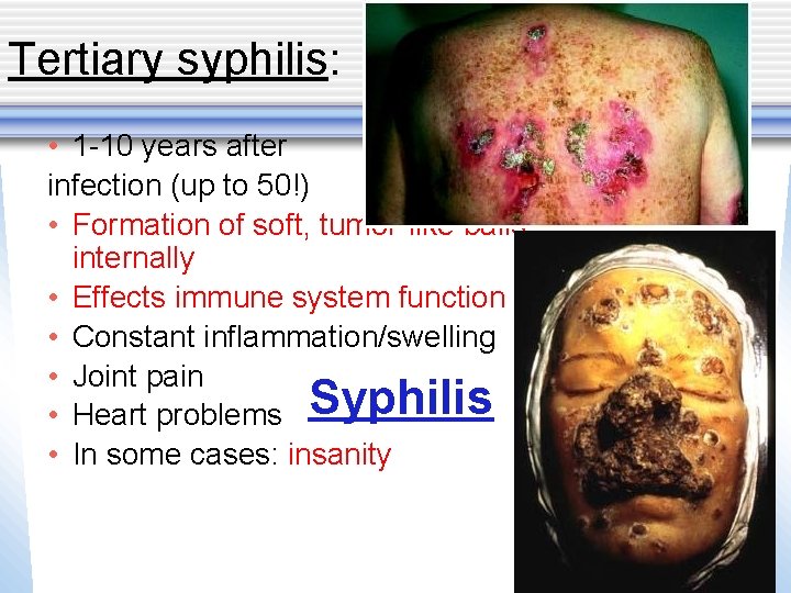 Tertiary syphilis: • 1 -10 years after infection (up to 50!) • Formation of