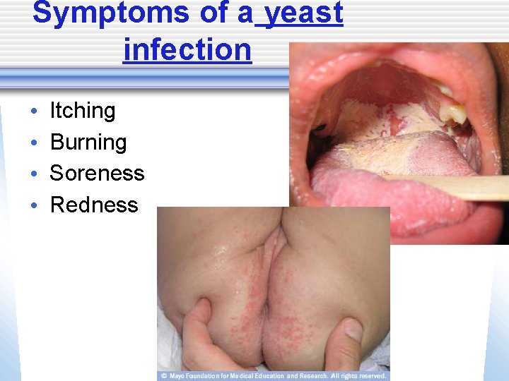 Symptoms of a yeast infection • • Itching Burning Soreness Redness 