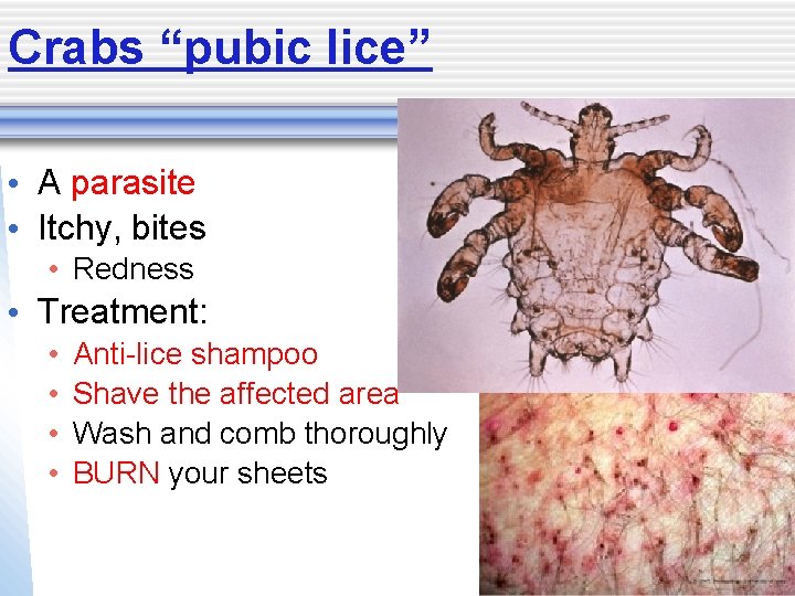 Crabs “pubic lice” • A parasite • Itchy, bites • Redness • Treatment: •