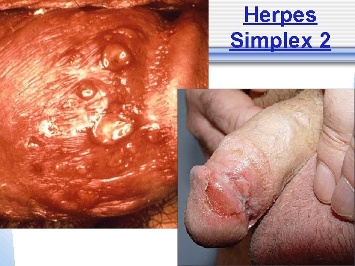 Herpes Simplex 2 