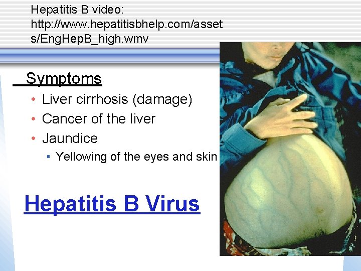 Hepatitis B video: http: //www. hepatitisbhelp. com/asset s/Eng. Hep. B_high. wmv Symptoms • Liver