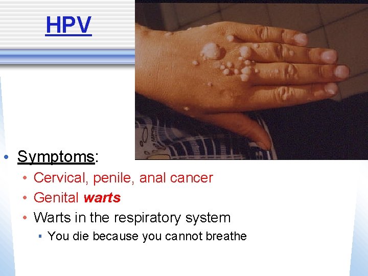 HPV • Symptoms: • Cervical, penile, anal cancer • Genital warts • Warts in