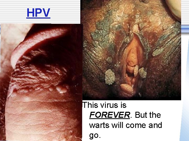 HPV This virus is FOREVER. But the warts will come and go. 