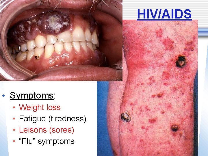 HIV/AIDS • Symptoms: • • Weight loss Fatigue (tiredness) Leisons (sores) “Flu” symptoms 