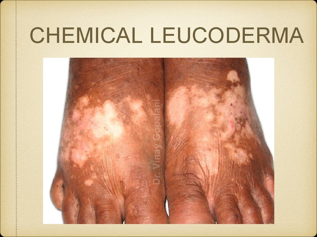 CHEMICAL LEUCODERMA 