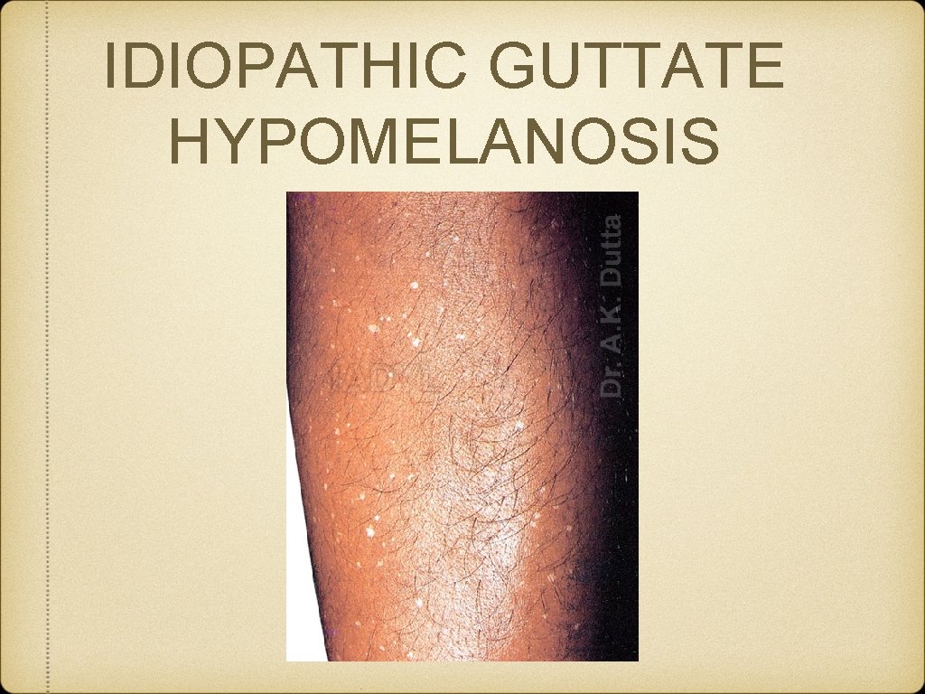 IDIOPATHIC GUTTATE HYPOMELANOSIS 