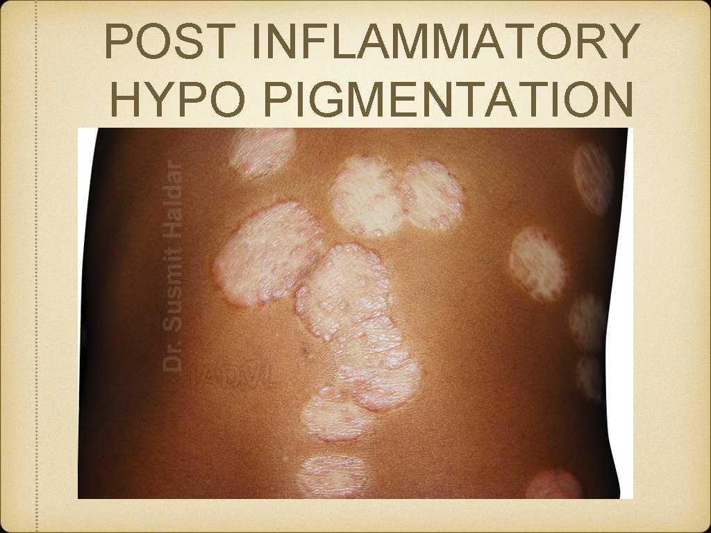 POST INFLAMMATORY HYPO PIGMENTATION 