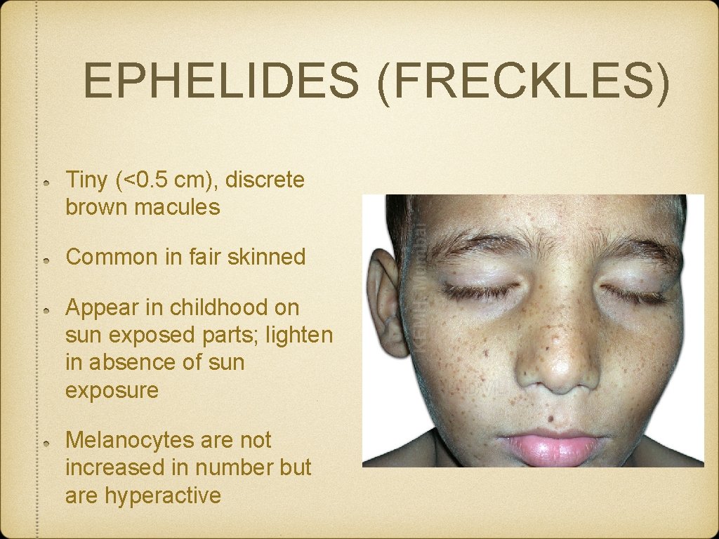 EPHELIDES (FRECKLES) Tiny (<0. 5 cm), discrete brown macules Common in fair skinned Appear