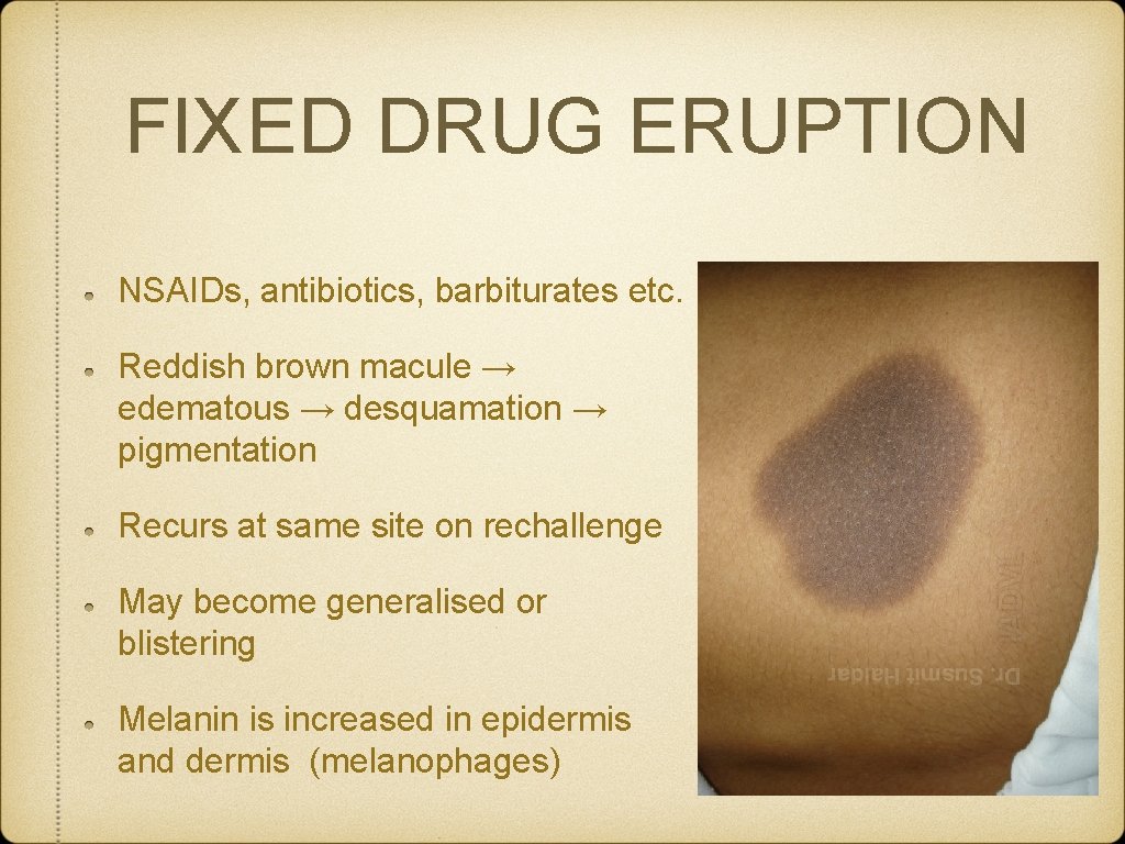 FIXED DRUG ERUPTION NSAIDs, antibiotics, barbiturates etc. Reddish brown macule → edematous → desquamation