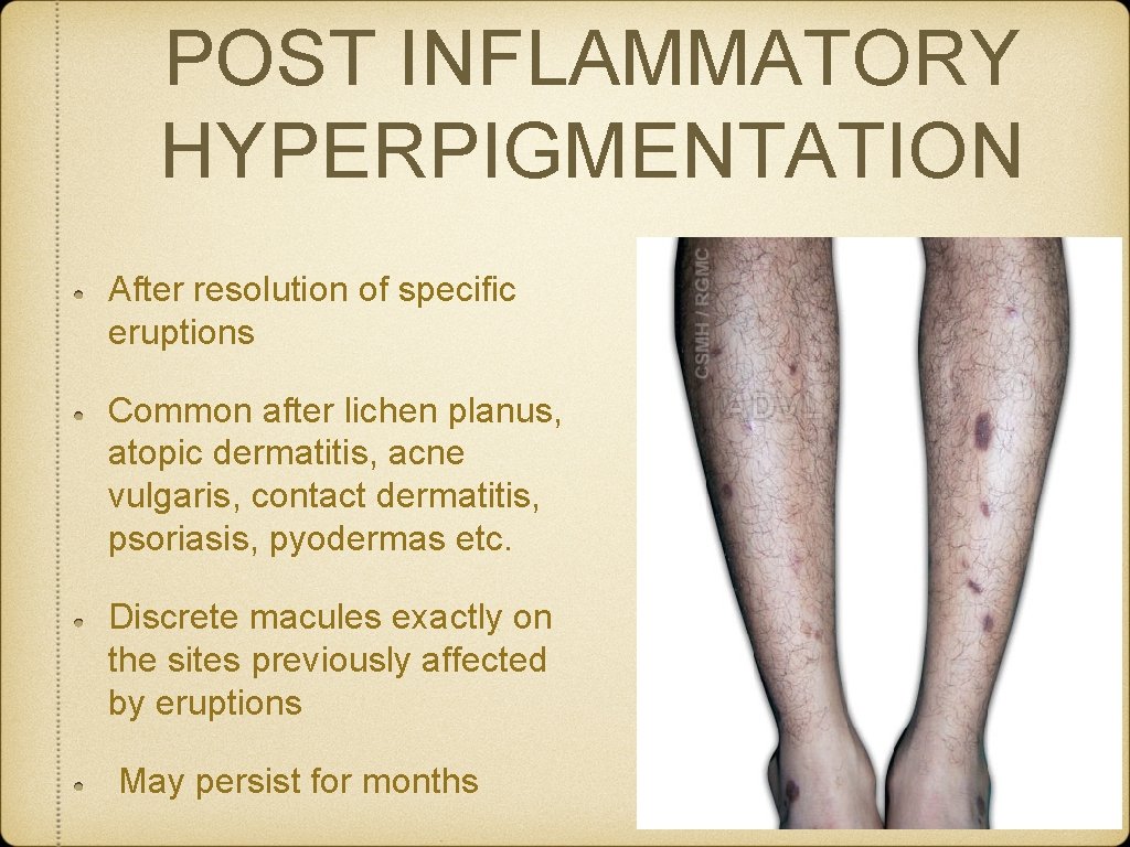 POST INFLAMMATORY HYPERPIGMENTATION After resolution of specific eruptions Common after lichen planus, atopic dermatitis,