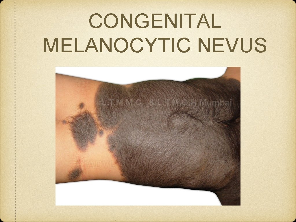 CONGENITAL MELANOCYTIC NEVUS 