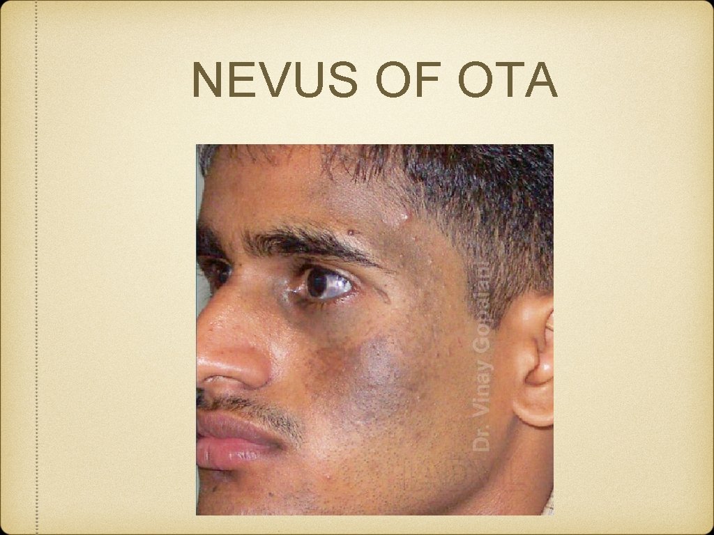 NEVUS OF OTA 