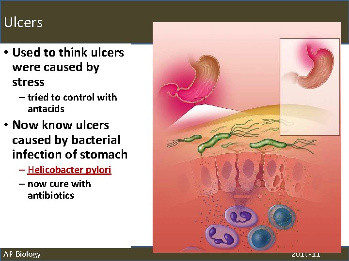 Ulcers • Used to think ulcers were caused by stress – tried to control