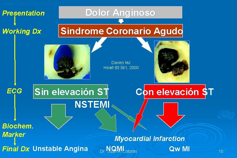 Hamm Lancet 358: 1533, 2001 Presentation Dolor Anginoso Working Dx Sindrome Coronario Agudo Davies