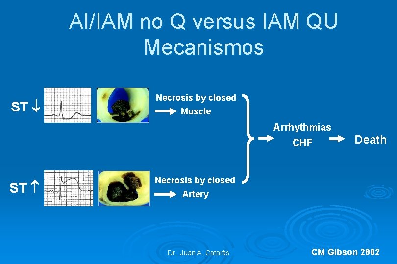 AI/IAM no Q versus IAM QU Mecanismos ST Necrosis by closed Muscle Arrhythmias CHF