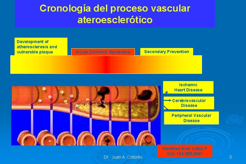 Cronología del proceso vascular ateroesclerótico Development of atherosclerosis and vulnerable plaque Acute Coronary Syndrome