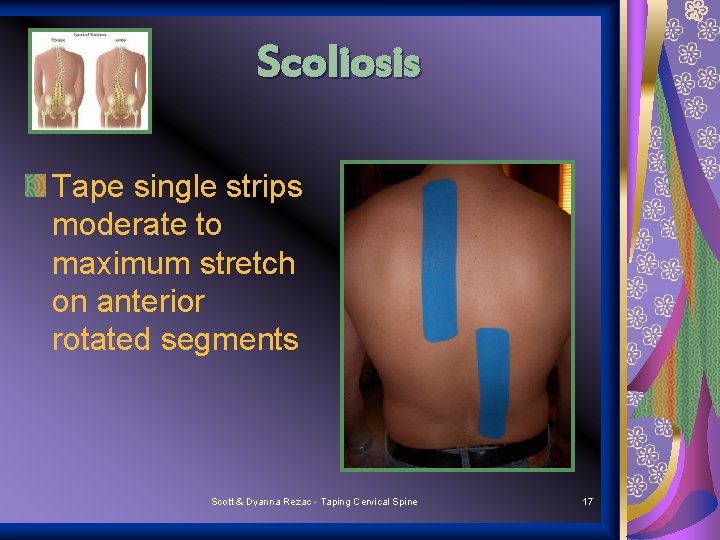 Scoliosis Tape single strips moderate to maximum stretch on anterior rotated segments Scott &