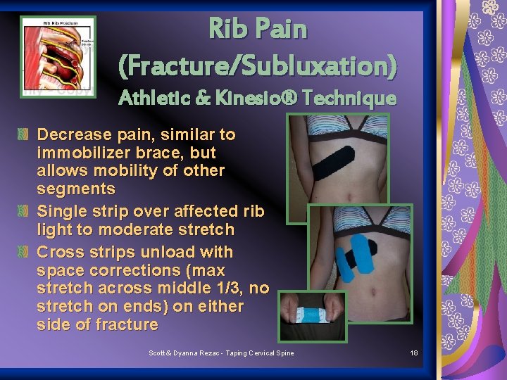 Rib Pain (Fracture/Subluxation) Athletic & Kinesio® Technique Decrease pain, similar to immobilizer brace, but