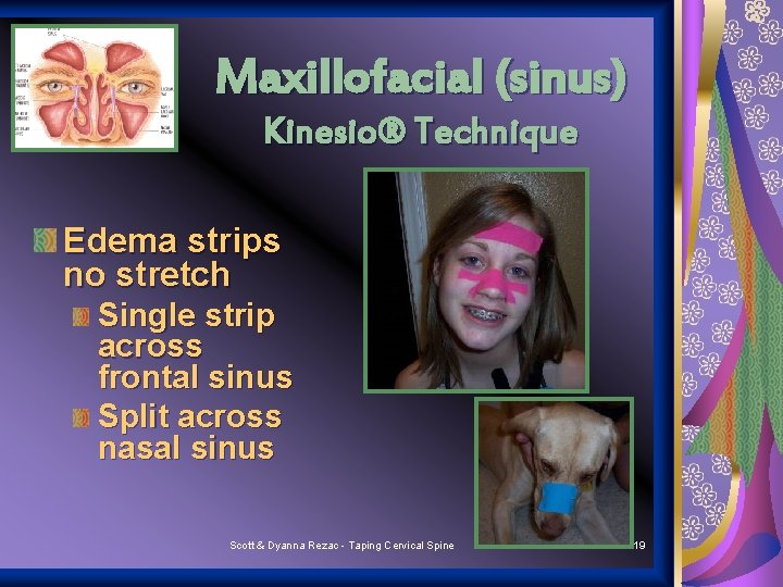 Maxillofacial (sinus) Kinesio® Technique Edema strips no stretch Single strip across frontal sinus Split