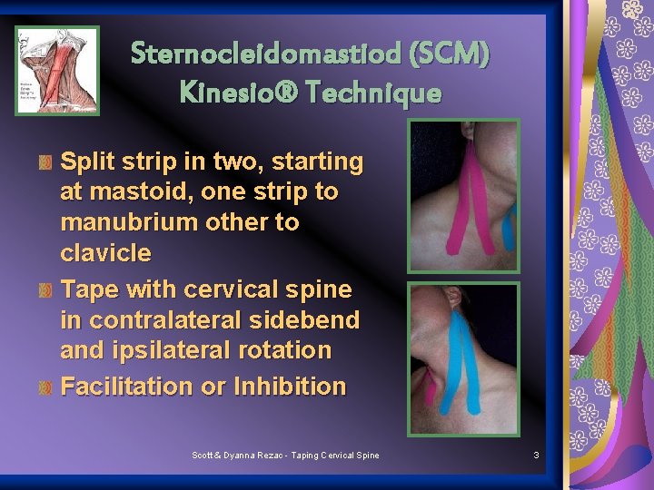 Sternocleidomastiod (SCM) Kinesio® Technique Split strip in two, starting at mastoid, one strip to
