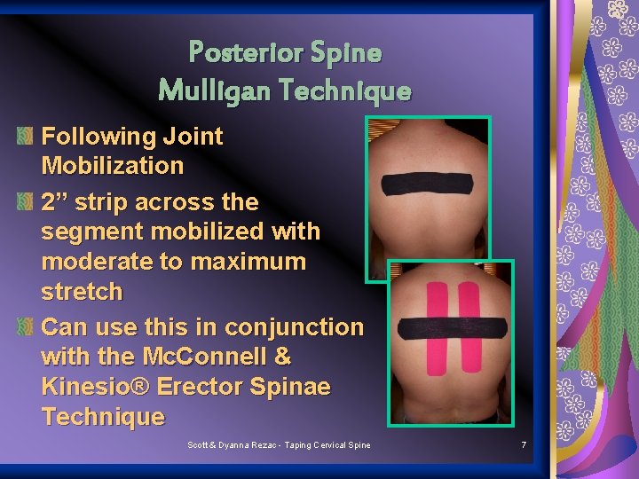Posterior Spine Mulligan Technique Following Joint Mobilization 2” strip across the segment mobilized with