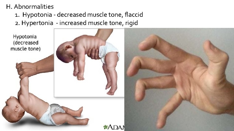 H. Abnormalities 1. Hypotonia - decreased muscle tone, flaccid 2. Hypertonia - increased muscle