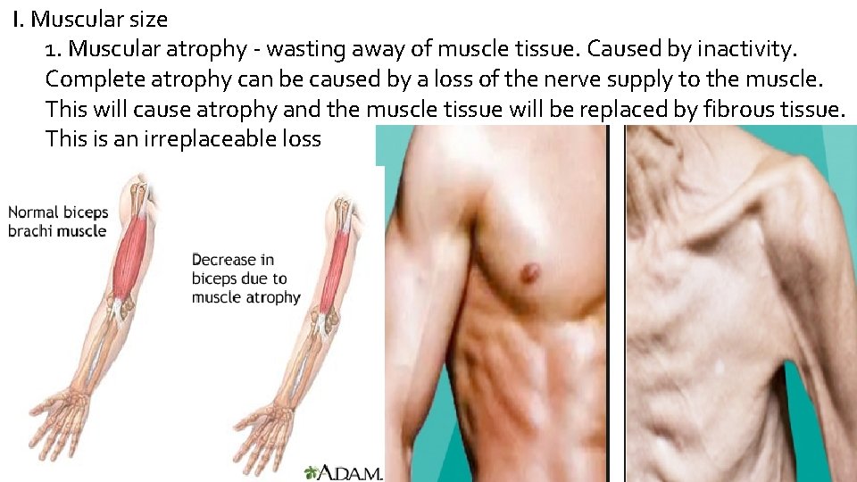 I. Muscular size 1. Muscular atrophy - wasting away of muscle tissue. Caused by