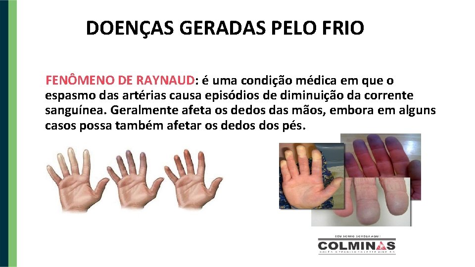 DOENÇAS GERADAS PELO FRIO FENÔMENO DE RAYNAUD: é uma condição médica em que o