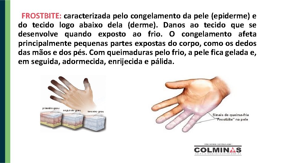 FROSTBITE: caracterizada pelo congelamento da pele (epiderme) e do tecido logo abaixo dela (derme).