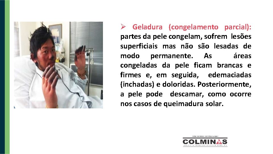  Geladura (congelamento parcial): partes da pele congelam, sofrem lesões superficiais mas não são