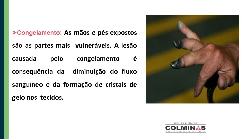  Congelamento: As mãos e pés expostos são as partes mais vulneráveis. A lesão