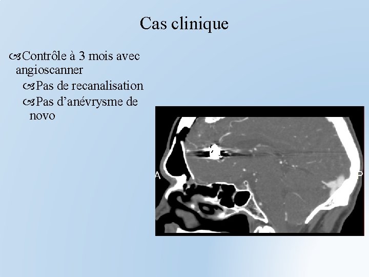 Cas clinique Contrôle à 3 mois avec angioscanner Pas de recanalisation Pas d’anévrysme de