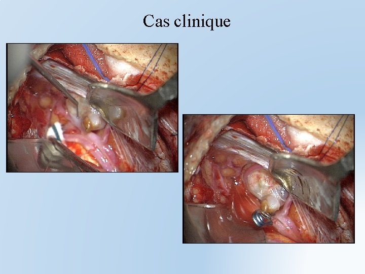 Cas clinique 