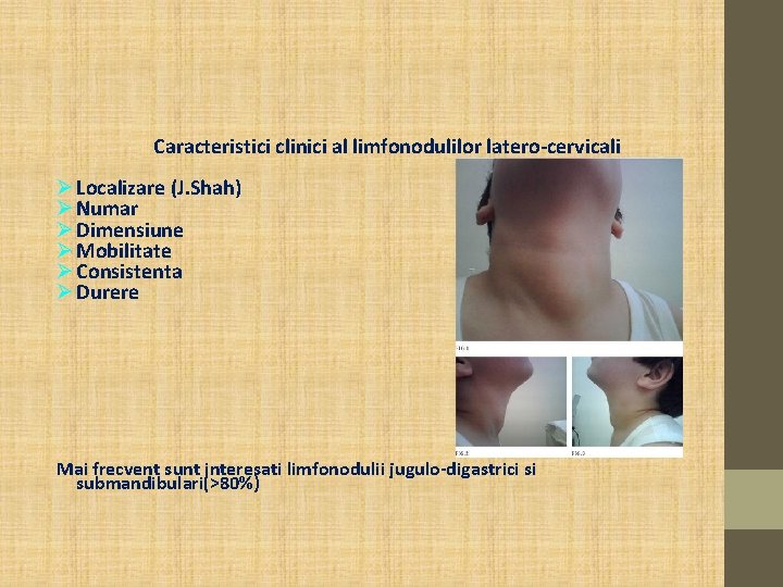 Caracteristici clinici al limfonodulilor latero-cervicali Localizare (J. Shah) Numar Dimensiune Mobilitate Consistenta Durere Mai Caracteristici clinici al limfonodulilor latero-cervicali Localizare (J. Shah) Numar Dimensiune Mobilitate Consistenta Durere Mai