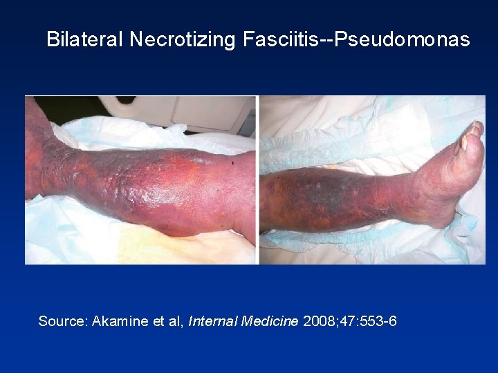 Bilateral Necrotizing Fasciitis--Pseudomonas Source: Akamine et al, Internal Medicine 2008; 47: 553 -6 