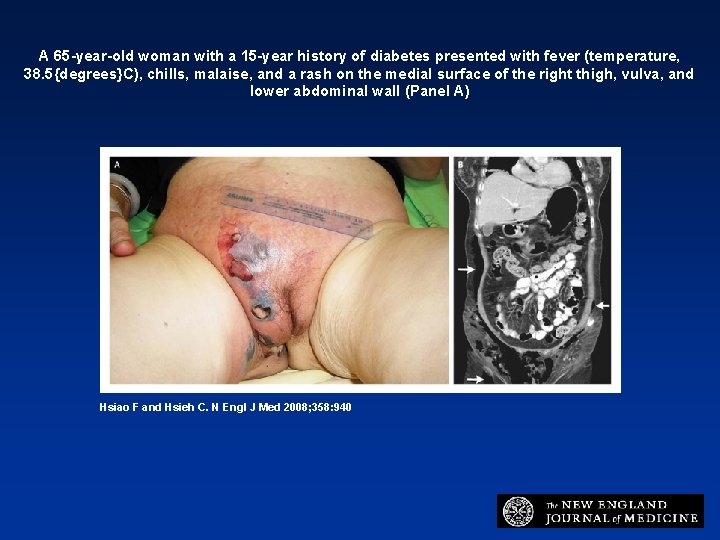 A 65 -year-old woman with a 15 -year history of diabetes presented with fever