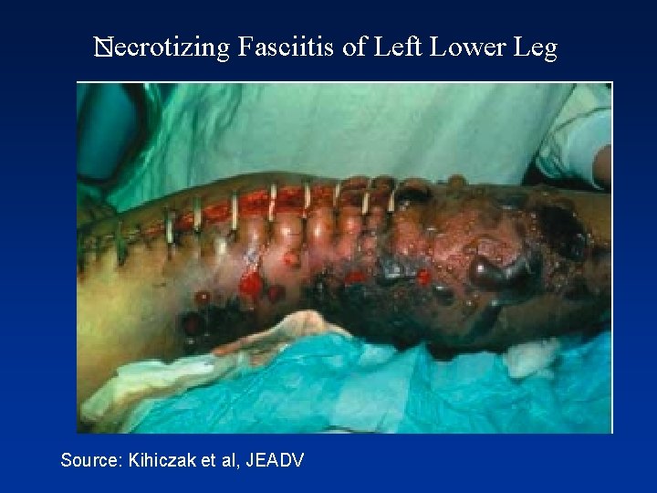 Necrotizing � Fasciitis of Left Lower Leg Source: Kihiczak et al, JEADV 