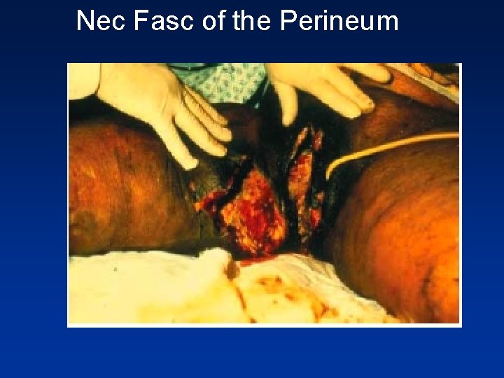 Nec Fasc of the Perineum 
