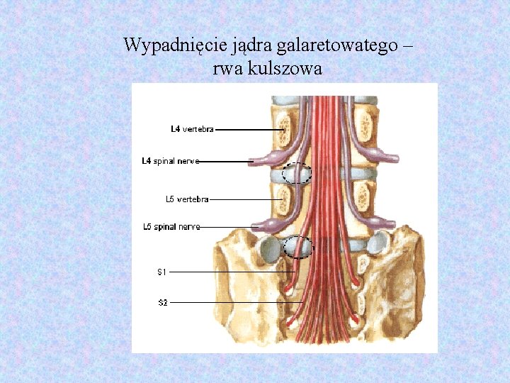 Wypadnięcie jądra galaretowatego – rwa kulszowa 