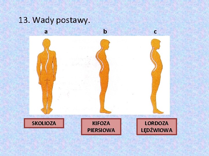 13. Wady postawy. a SKOLIOZA b KIFOZA PIERSIOWA c LORDOZA LĘDŹWIOWA 