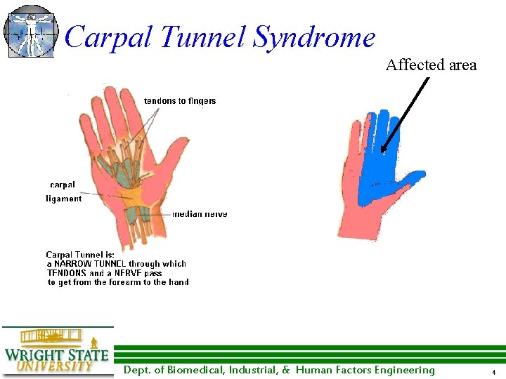 Carpal Tunnel Syndrome Affected area Dept. of Biomedical, Industrial, & Human Factors Engineering 4 Carpal Tunnel Syndrome Affected area Dept. of Biomedical, Industrial, & Human Factors Engineering 4