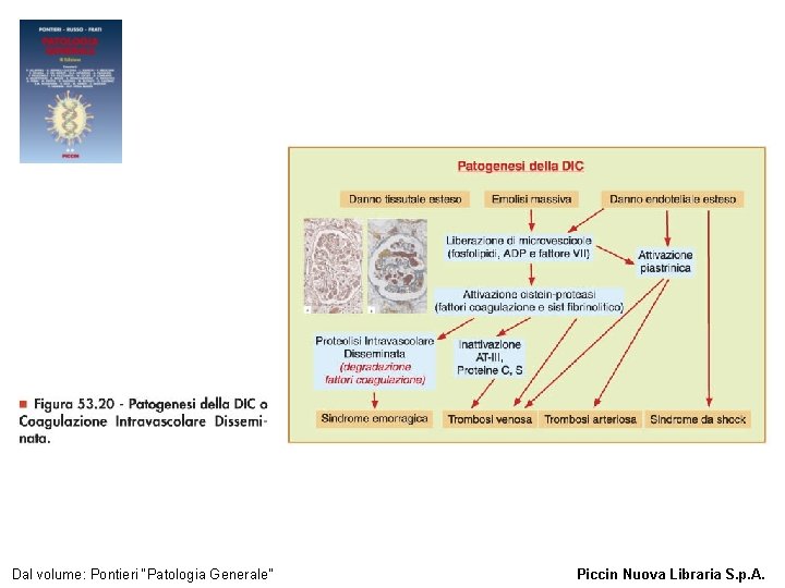 Figura 53. 20 - Patogenesi della DIC o Coagulazione Intravascolare Disseminata. Dal volume: Pontieri