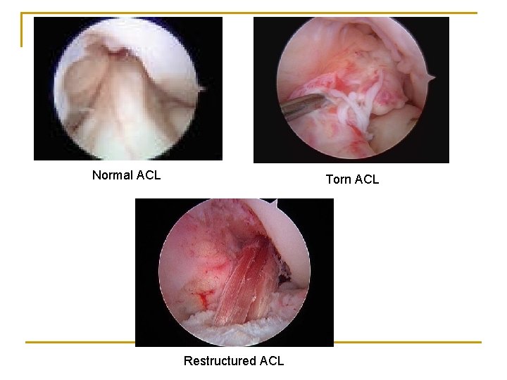 Normal ACL Torn ACL Restructured ACL 