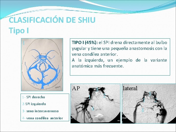 CLASIFICACIÓN DE SHIU Tipo I 1 TIPO I (45%): el SPI drena directamente al CLASIFICACIÓN DE SHIU Tipo I 1 TIPO I (45%): el SPI drena directamente al